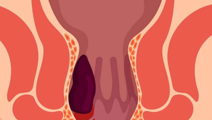 Tuvalette Telefon Alışkanlığı Hemoroid Yapabilir!