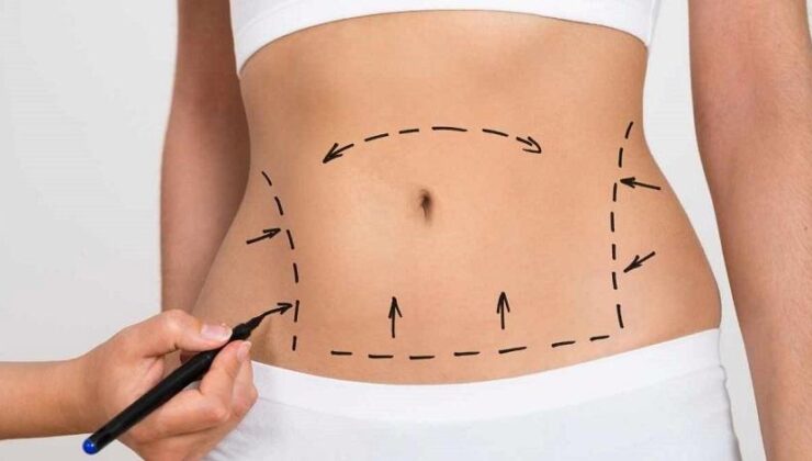 Karın Germe Ameliyatı