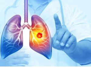 Her Yıl 25 Bin Akciğer Kanseri Hadisesi Önlenebilir