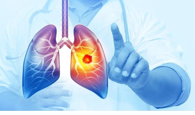 Her Yıl 25 Bin Akciğer Kanseri Hadisesi Önlenebilir