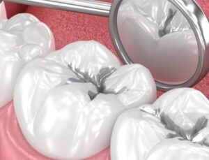Amalgam Dolgular Değiştirilmeli mi?