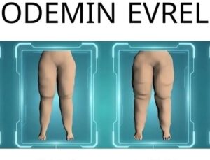 Su İçsem Yarıyor Diyorsanız Lipödem Olabilirsiniz
